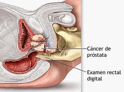 Curso de Cancer de Prostata